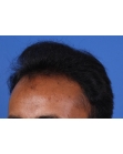 Before Hair Transplant&nbsp;Front